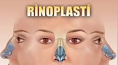 RİNOPLASTİ(ESTETİK BURUN AMELİYATI) SONRASI MALPRAKTİS İDDİASI İLE AÇILAN DAVADA ARAŞTIRILMASI GEREKEN HUSUSLAR.